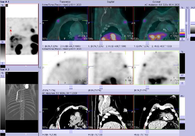 Obr. č. 8: Fúze obrazů SPECT a CT – vyšetření 4 hod. po aplikaci radiofarmaka. Zaměřeno na ložisko v pravém prsu.