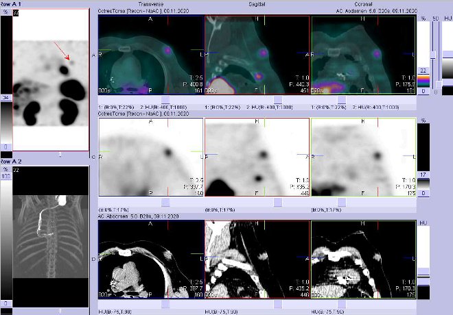 Obr. č. 9: Fúze obrazů SPECT a CT – vyšetření 4 hod. po aplikaci radiofarmaka. Zaměřeno na ložisko v levém prsu.