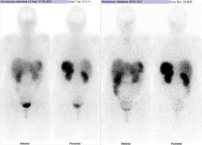 Obr. č. 1: Celotělová scintigrafie v přední a zadní projekci. Vyšetření 5 hod. (vlevo) a 24 hod. (vpravo) po aplikaci radioindikátoru.