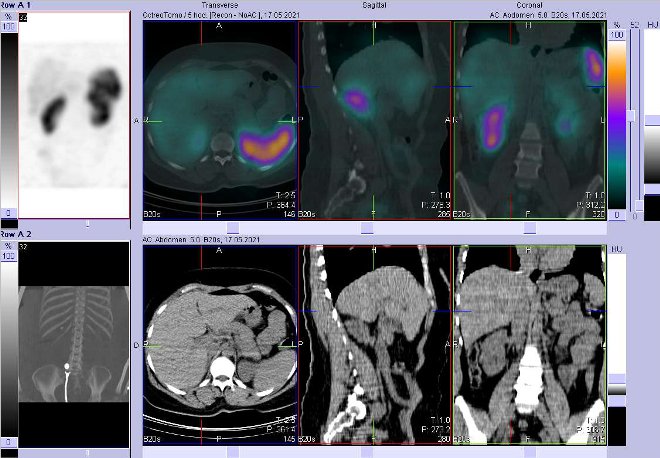 Obr. č. 3: Fúze obrazů SPECT a CT – vyšetření břicha a pánve 5 hod. po aplikaci radiofarmaka.