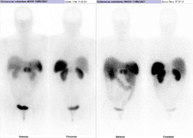 Obr. č. 1: Celotělová scintigrafie v přední a zadní projekci. Vyšetření 4 hod. (vlevo) a 24 hod. (vpravo) po aplikaci radioindikátoru.
