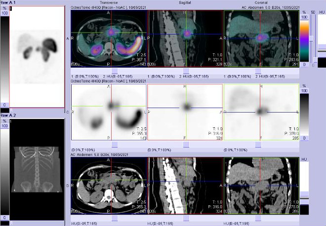 Obr. č. 2: Fúze obrazů SPECT a CT – vyšetření 4 hod. po aplikaci radiofarmaka. Zaměřeno na ložisko v pankreatu.