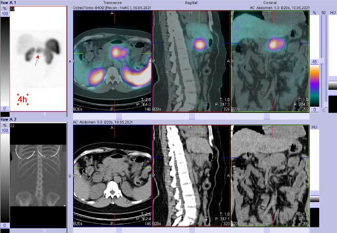 Obr. č. 3: Fúze obrazů SPECT a CT – vyšetření 4 hod. po aplikaci radiofarmaka. Zaměřeno na ložisko v pankreatu.