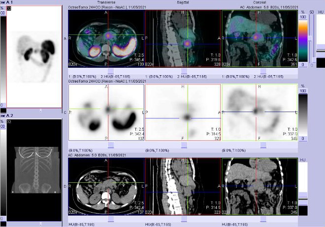 Obr. č. 4: Fúze obrazů SPECT a CT – vyšetření 24 hod. po aplikaci radiofarmaka. Zaměřeno na ložisko v pankreatu.