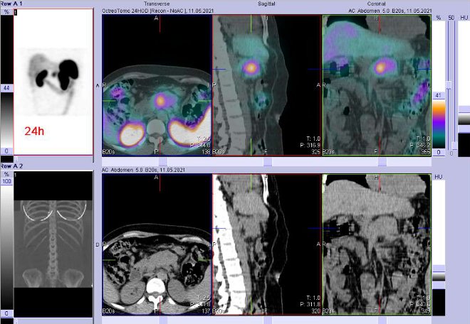 Obr. č. 5: Fúze obrazů SPECT a CT – vyšetření 24 hod. po aplikaci radiofarmaka. Zaměřeno na ložisko v pankreatu.