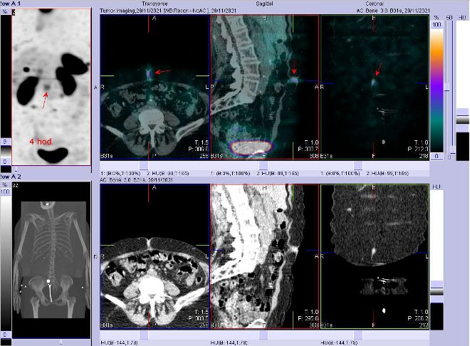 Obr. č. 10: Fúze obrazů SPECT a CT. Zaměřeno na ložisko v podkoží. Vyšetření 4 hod. po aplikaci OctreoScanu.