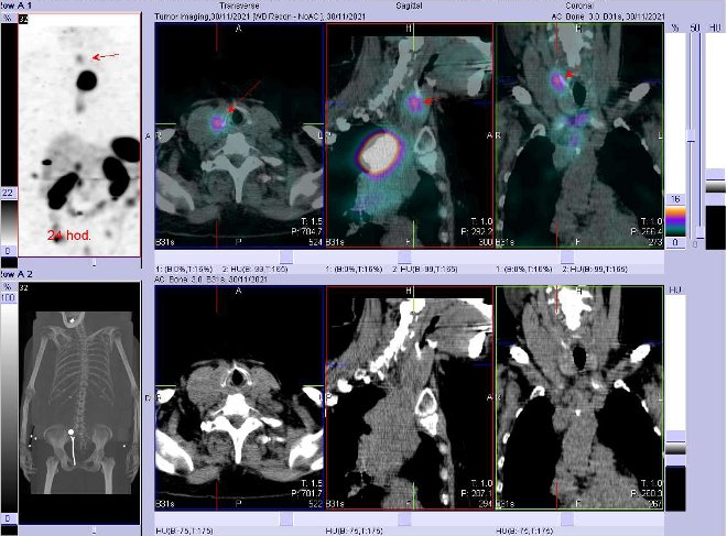 Obr. č. 12: Fúze obrazů SPECT a CT. Zaměřeno na ložisko v pravém laloku štítné žlázy. Vyšetření 24 hod. po aplikaci OctreoScanu.