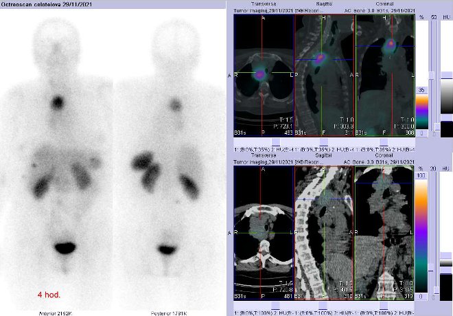 Obr.č.2: Celotělová scintigrafie v přední a zadní projekci a fúze SPECT/CT 4 hod. po aplikaci OctreoScanu. Zaměřeno na ložisko v mediastinu.