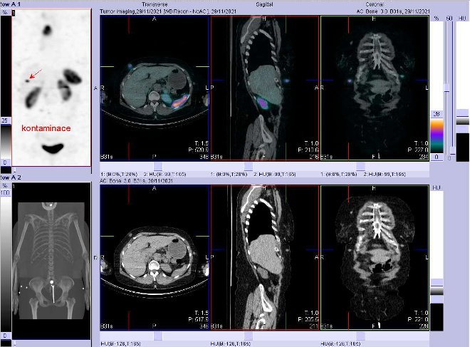Obr. č. 3: Fúze obrazů SPECT a CT. Zaměřeno na ložisko v podkoží. Vyšetření 4 hod. po aplikaci OctreoScanu.