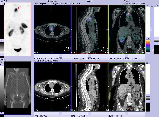 Obr. č. 4: Fúze obrazů SPECT a CT. Zaměřeno na ložisko v mediastinu. Vyšetření 4 hod. po aplikaci OctreoScanu.