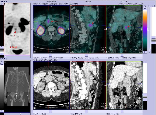 Obr. č. 8: Fúze obrazů SPECT a CT. Zaměřeno na ložisko v blízkosti pankreatu Vyšetření 4 hod. po aplikaci OctreoScanu.