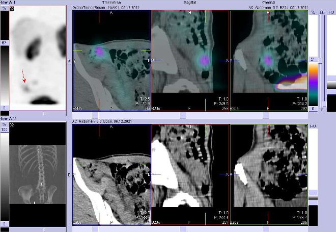 Obr. č. 2: Fúze SPECT/CT 4 hod. po aplikaci OctreoScanu. Zaměřeno na ložisko v pánvi vpravo.