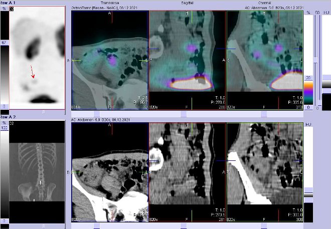 Obr. č. 3: Fúze obrazů SPECT a CT. Zaměřeno na ložisko v pánvi vpravo. Vyšetření 4 hod. po aplikaci OctreoScanu.