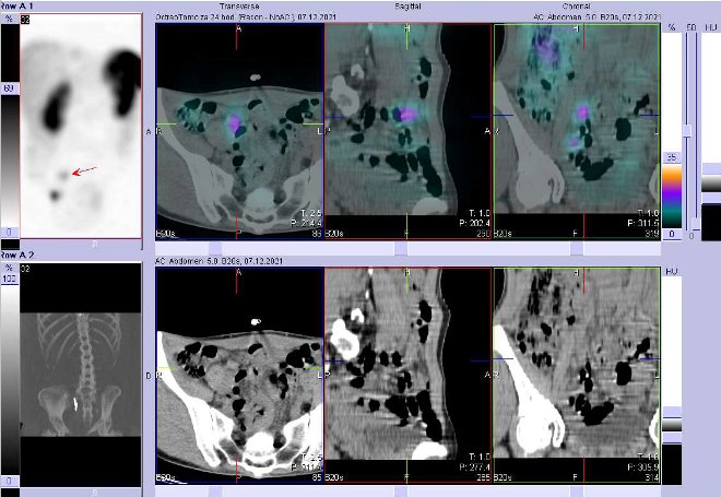 Obr. č. 5: Fúze obrazů SPECT a CT. Zaměřeno na ložisko v pánvi vpravo. Vyšetření 24 hod. po aplikaci OctreoScanu.