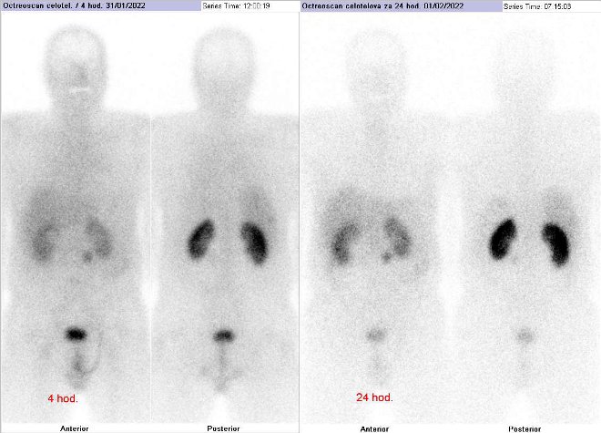 Obr.1: Celotělová scintigrafie v přední a zadní projekci 4 (vlevo) a 24 hod. (vpravo) po aplikaci OctreoScanu.