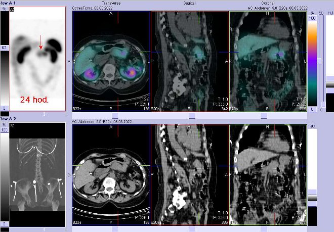 Obr. . 6: Fze obraz SPECT a CT  vyeten 24 hod. po aplikaci radiofarmaka. Zameno na loisko v pankreatu.