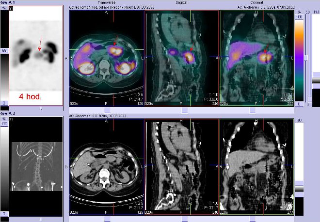Obr. . 2: Fze obraz SPECT a CT  vyeten 4 hod. po aplikaci radiofarmaka. Zameno na loisko v pankreatu.