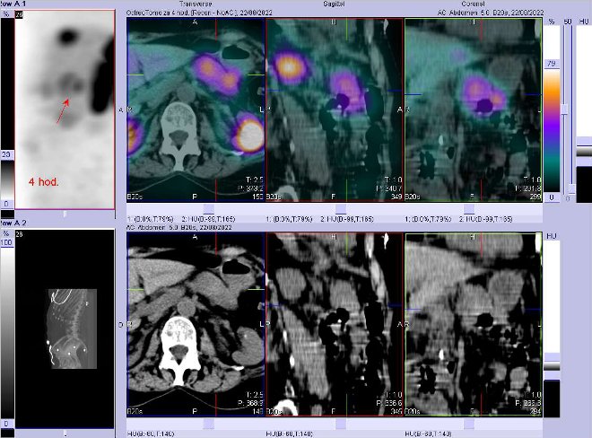 Obr. . 5: Fze obraz SPECT a CT  vyeten 4 hod. po aplikaci radiofarmaka. Zameno na loisko vpankreatu.