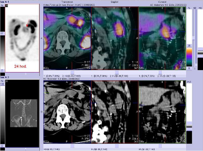 Obr. . 7: Fze obraz SPECT a CT  vyeten 24 hod. po aplikaci radiofarmaka. Zameno na loisko v pankreatu.