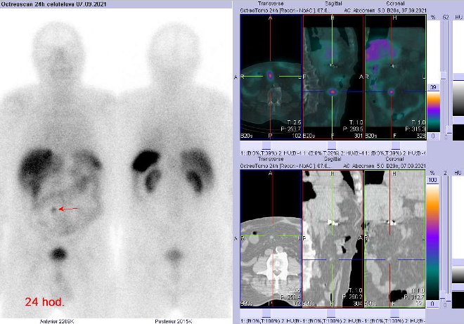 Obr..2: Celotlov scintigrafie a fze obraz SPECT a CT  vyeten 24 hod. po aplikaci radiofarmaka. Zameno na uzlinu vmezenteriu vpravo paramediln.