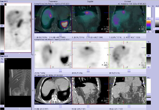 Obr.3: Fze obraz SPECT a CT  vyeten 24 hod. po aplikaci radiofarmaka. Zameno na loisko v pravm jaternm laloku kraniomediln.