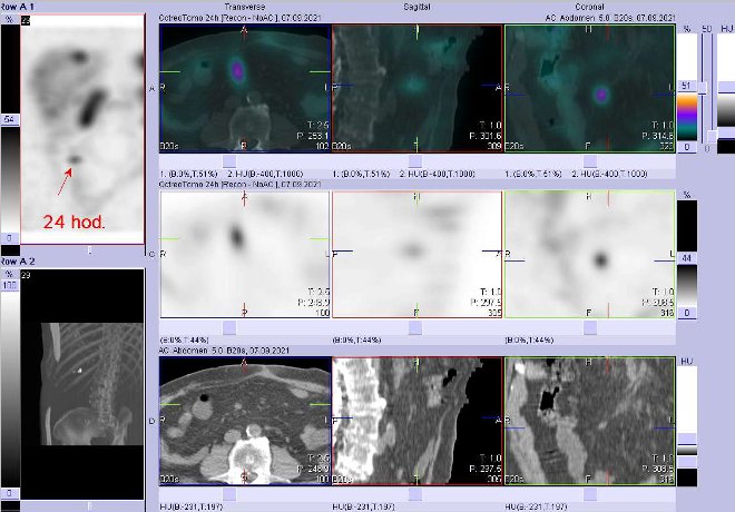 Obr. . 4: Celotlov scintigrafie a fze obraz SPECT a CT  vyeten 24 hod. po aplikaci radiofarmaka. Zameno na uzlinu vmezenteriu vpravo paramediln.