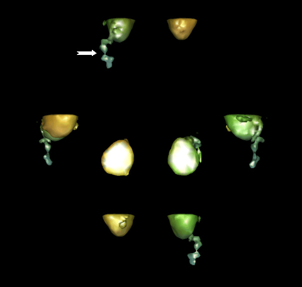 Obr. 4: 3D zobrazení s patologickou ložiskovou depozicí radiofarmaka(99mTc CEA Scan) v oblasti pravého mesogastria.