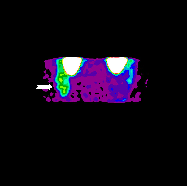 Obr. 5: Zobrazení patologické ložiskové depozice radiofarmaka v oblasti pravého mesogastria metodou maximum pixel raytrace v AP projekci.