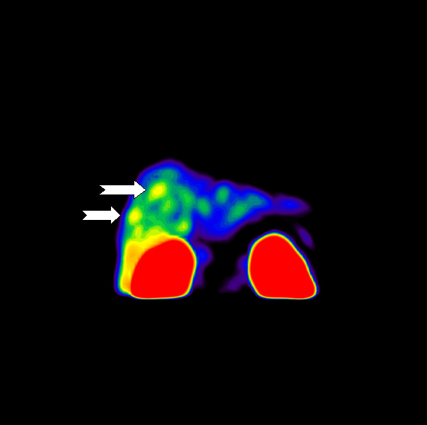 Obr. 5: Zobrazení patologické ložiskové depozice radiofarmaka v oblasti jater metodou maximum pixel raytrace v AP projekci.
