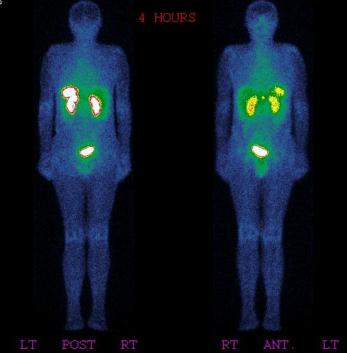 Obr. 1.: Celotělová scintigrafie s 111In-pentetreotidem (OctreoScan®), přední a zadní projekce, 4 hodiny po i.v. aplikaci radiofarmaka. Gastrinom v tělu pankreatu.