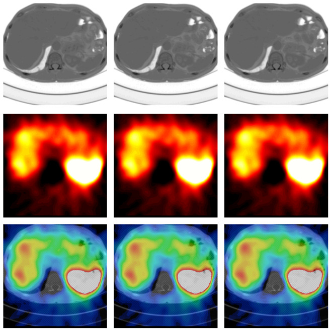Obr.5.: Fúze anatomických obrazů z CT a funkčních (SPECT) v projekcích transversálních na meta jater. Horní řada zobrazuje CT, druhá SPECT, na poslední je pak jejich fúze.