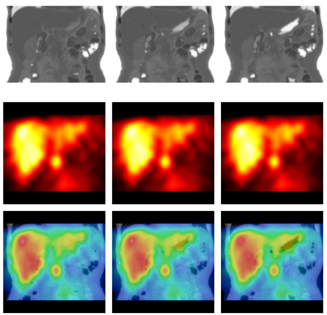 Obr. 7.: Fúze anatomických obrazů z CT a funkčních (SPECT) v projekcích koronárních na meta do jater a radixu mesenteria. Pořadí a barevná škála jako u obr. 5.