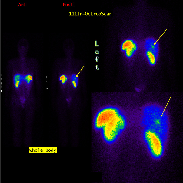 Obr.1.: 111In-OctreoScan metodou „whole body“,kontrolní vyšetření 8/06 s nálezem již pouze jedné ložiskové depozice radiofarmaka v oblasti jater.