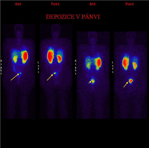 Obr.1.: Scintigrafie pomocí 111In-OctreoScan metodou „whole body“ za 24 a 48 hodin po aplikaci radiofarmaka s patologickou ložiskovou depozicí v pánvi.
