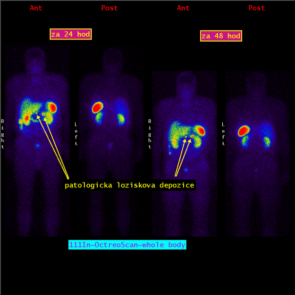 Obr.1.: Scintigrafie pomocí 111In-OctreoScan metodou „whole body“ za 24 a 48 hodin po aplikaci radiofarmaka s patologickými ložiskovými depozicemi v oblasti epigastria, méně výrazně pak v mesogastriu a levé kyčli.