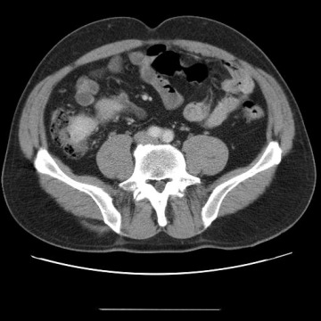 Obr.č.6: CT vyšetření břicha