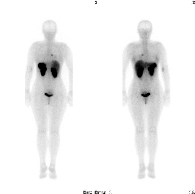 Obr.1: Celotělový scan. Jasně zobrazené patologické ložisko v hrudníku.