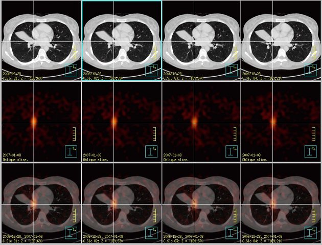 Obr.3: Fúze obrazů – transversální řezy. Šedá škála zvolena pro CT obrazy, červená škála pro SPECT, dolní řada jsou fúzované obrazy. Křížem označený tumor.