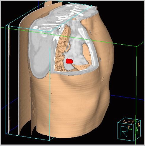 Obr.7: Fúze v 3D obraze - výřez v zobrazení transversálním/koronárním/sagitálním. Tumor je zobrazen červeně.