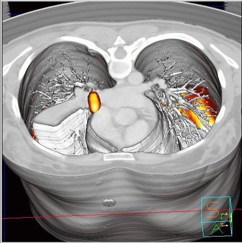 Obr.6: Fúze v 3D obraze – transversální řez. Tumor (zobrazen červenožlutě) naléhající na střední bronchus s atelektázou.