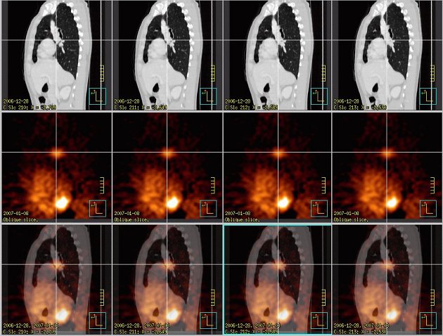 Obr.5: Fúze obrazů – sagitální řezy. Šedá škála zvolena pro CT obrazy, červená škála pro SPECT, dolní řada jsou fúzované obrazy. Křížem označený tumor.