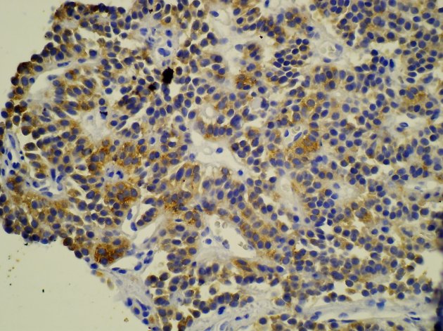 Obr.9: Histologický řez dobře diferencovaného neuroendokrinního karcinomu. Barvení na neuron specifickou enolázu (NSE).