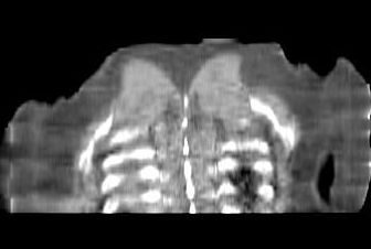Obr. 4.: CT hrudníku, koronární řez.