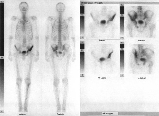 Obr. č. 2: Celotělová scintigrafie skeletu v přední a zadní projekci a statické scintigramy pánve