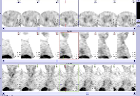 Obr.č.2: Tomografická scintigrafie hrudníku 5 hod. po aplikaci OctreoScanu