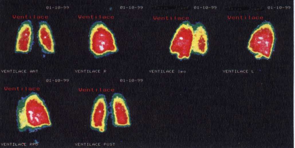 UltraVent: ventilan sken