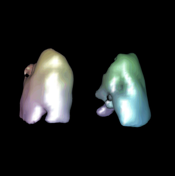 Obr.5.: 3D zobrazen perfze plicn-perfzn vpadek laterobasln vlevo.