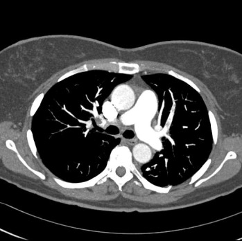 Obr. . 3: CT plicn angiografie