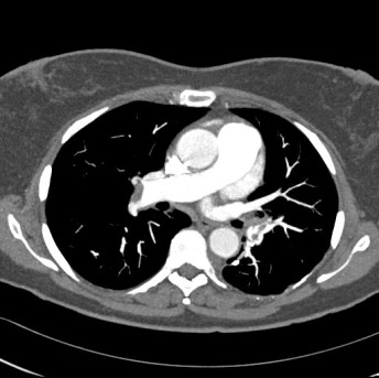 Obr. . 4: CT plicn angiografie