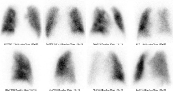Obr. . 1: Perfuzn scintigrafie plic na dvoudetektorov tomografick kamee